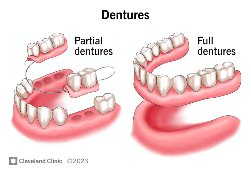 Types of dentures