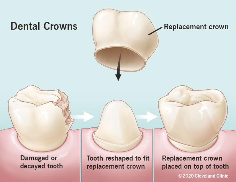 Dental crowns