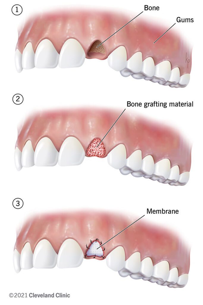 Bone Grafting