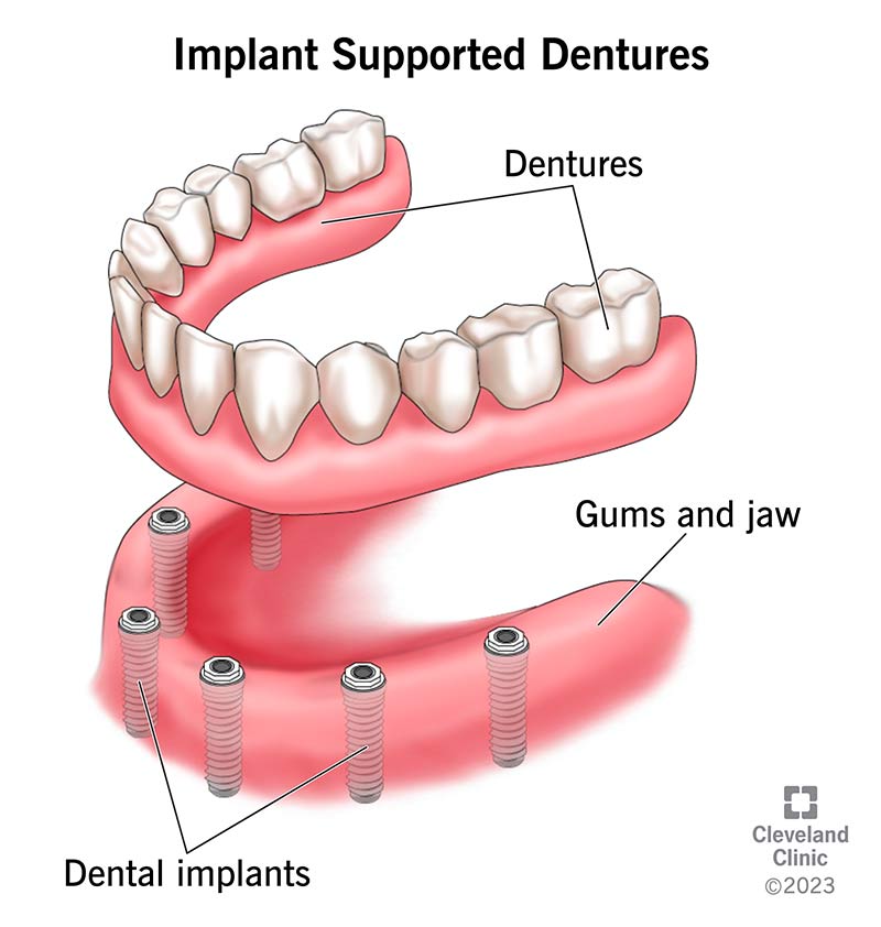 Implant Supported Dentures