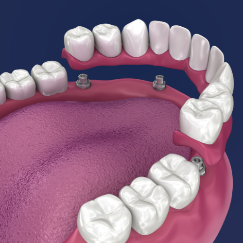 All on 4 dental implants