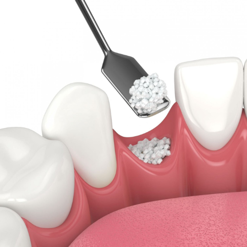 Bone Grafting