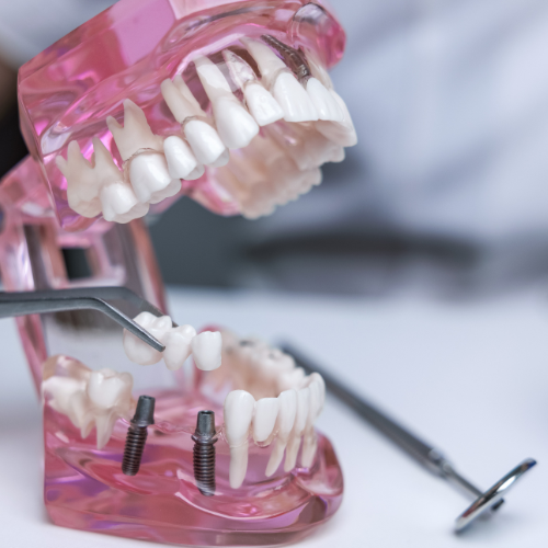 Dental Bridges