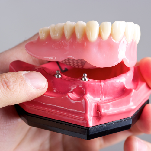 Implant Supported Dentures