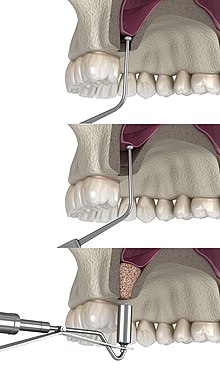 sinus lift implant