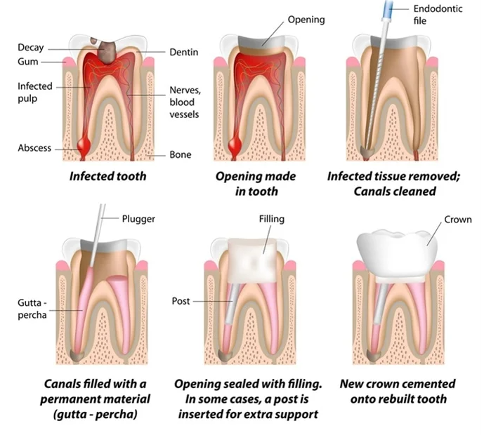 root canal procedure