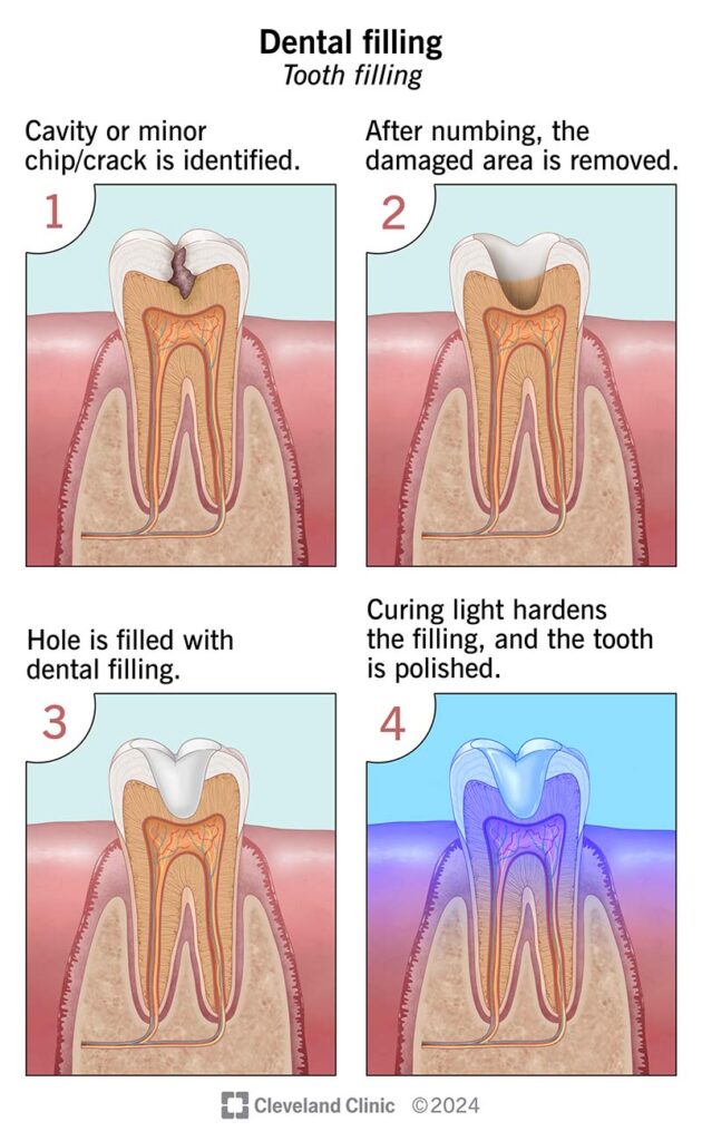 dental fillings