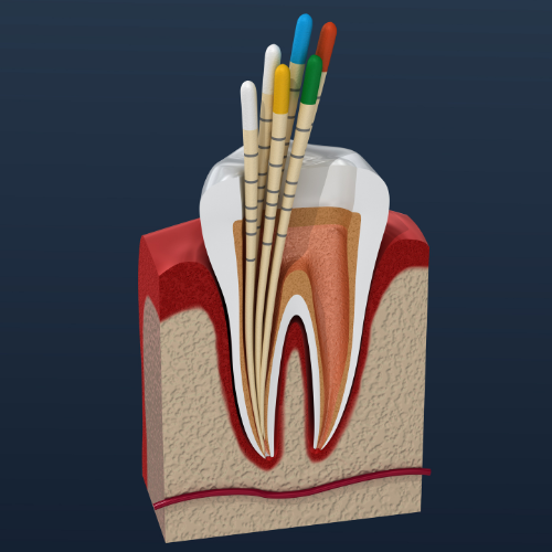 root canal