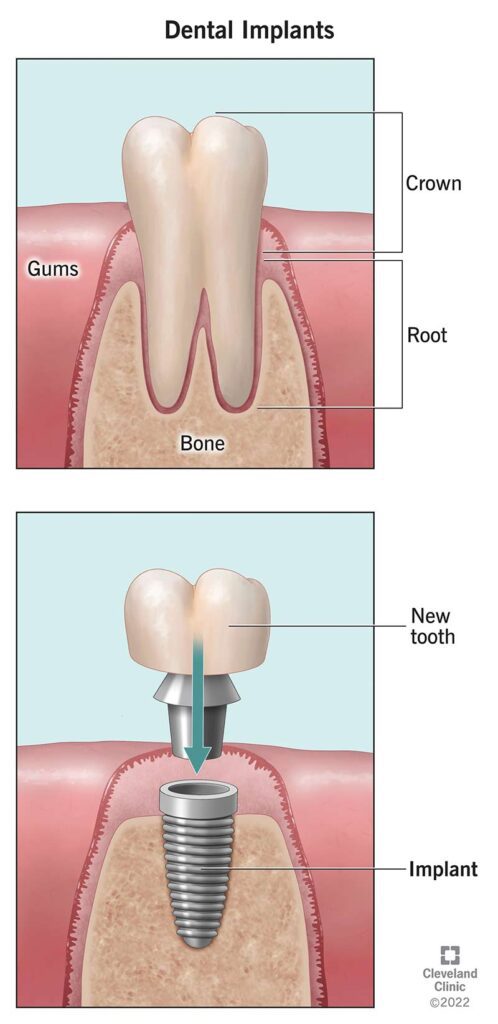 Dental Implants