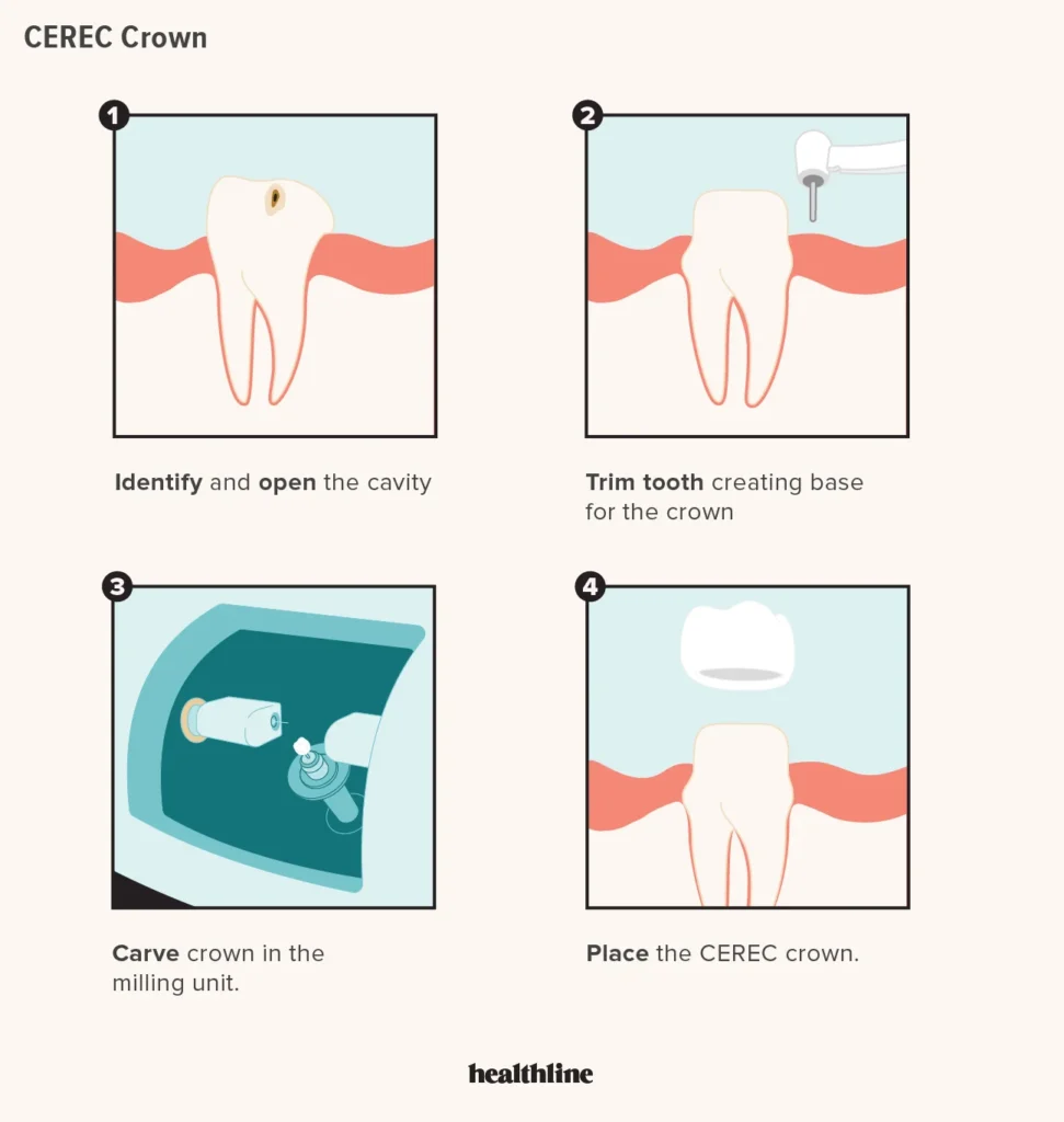 Same Day Crowns(CEREC)