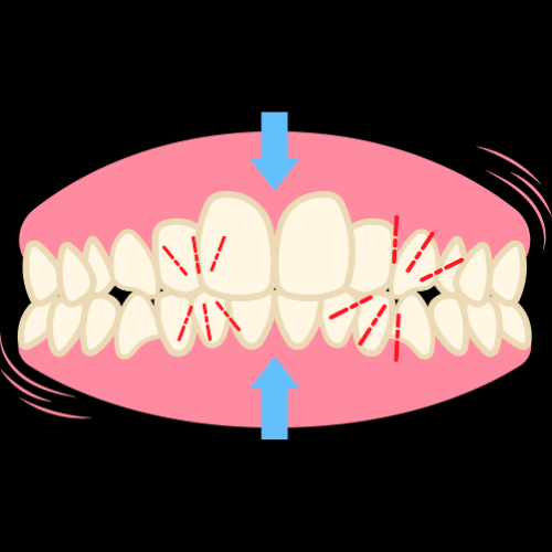 Bruxism Grinding