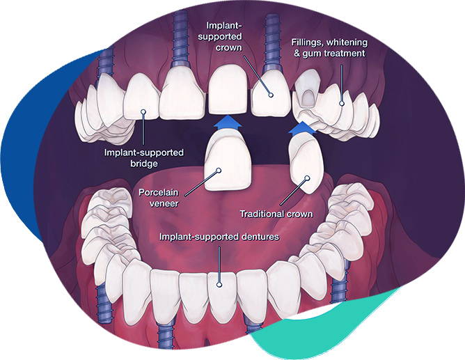 Full Mouth Rehabilitation