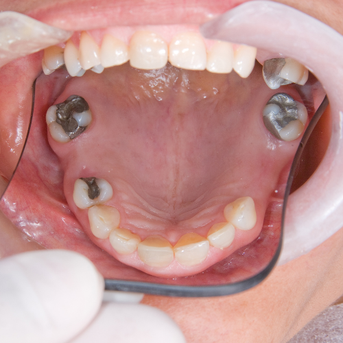 Full Mouth Rehabilitation