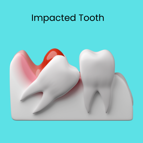 Impacted Tooth