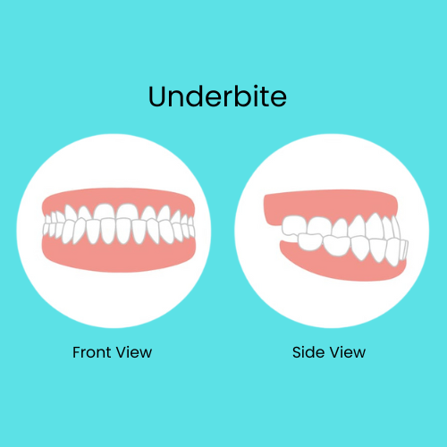 Underbite