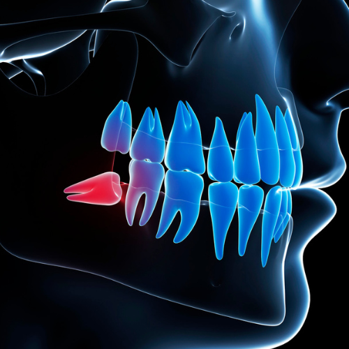 wisdom Tooth Removal