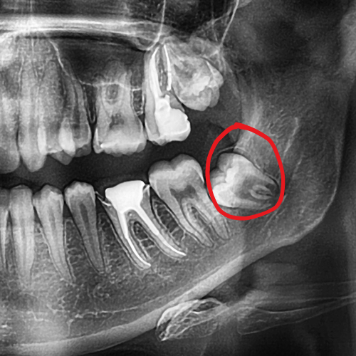 Wisdom Tooth removal