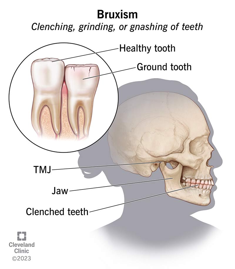 Bruxism teeth grinding