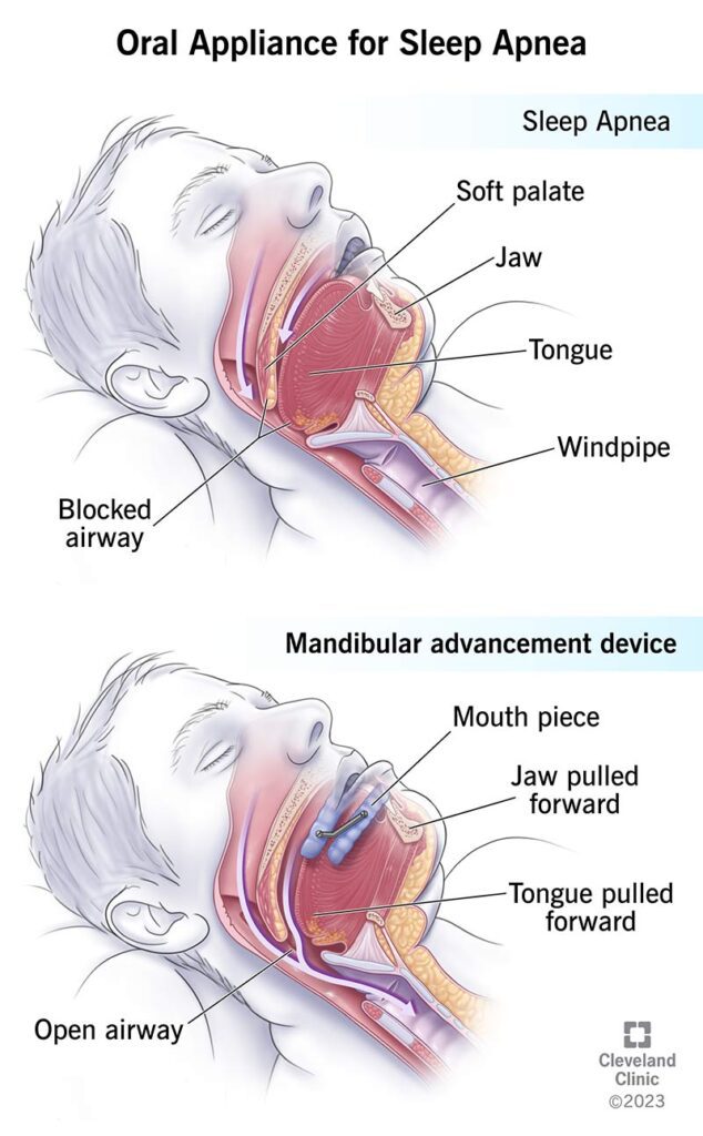 Sleep Apnea treatment using oral appliances